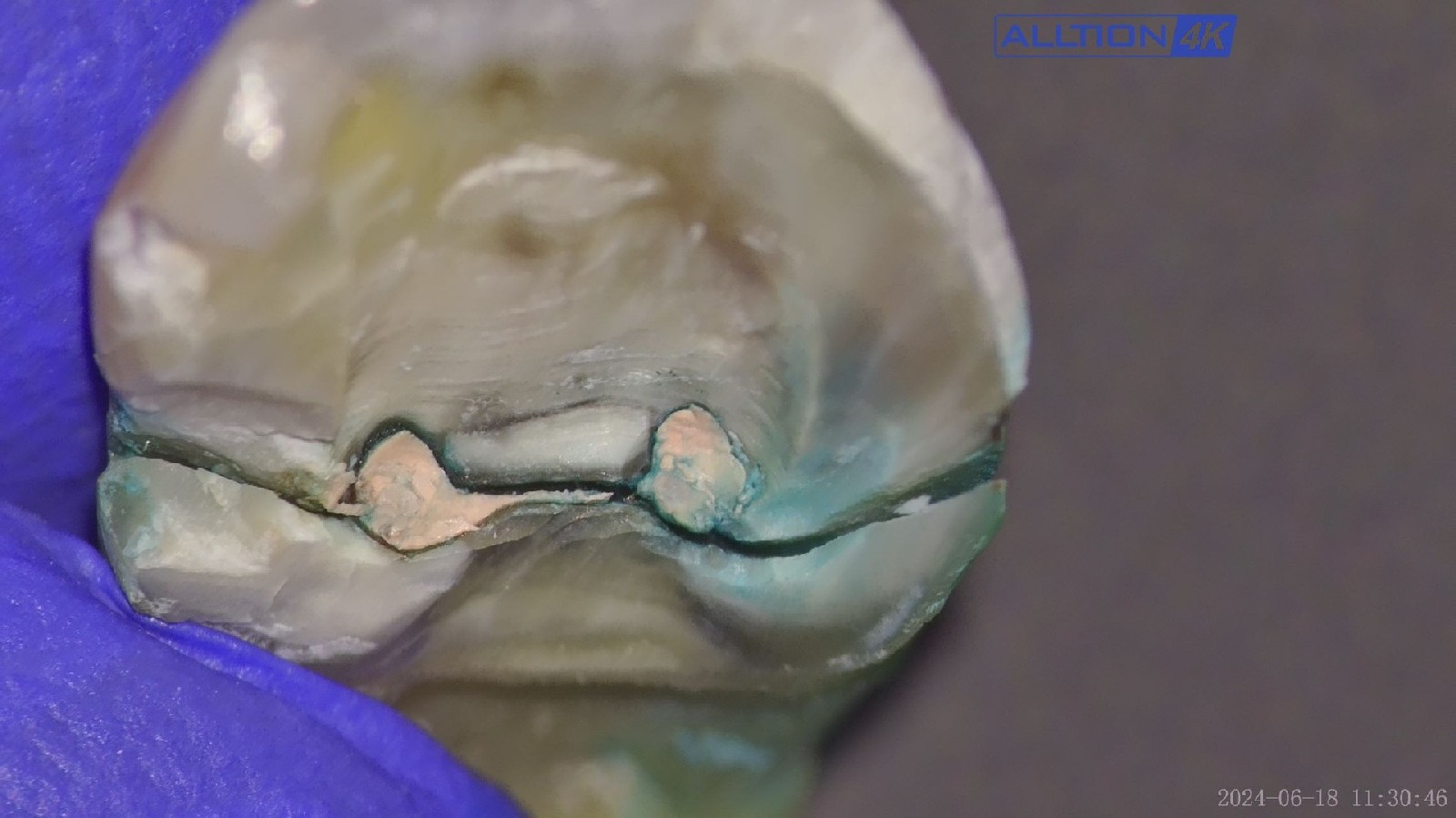 Dr. Carlos Saucedo, Vice President of the Mexican Endodontic Association, Has Highly Praised the Clarity of the Alltion Microscope